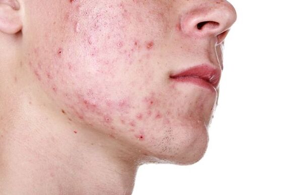 Symptômes du parasite de la démodécie sous-cutanée sur le visage