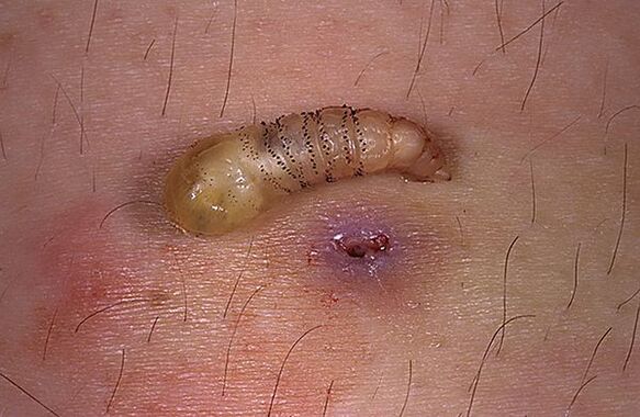 parasite larvaire sous-cutané de l'homme