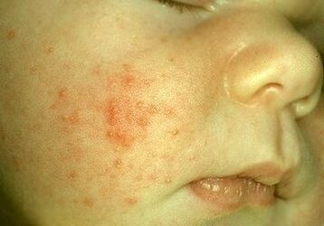 Des parasites sous la peau d'un enfant